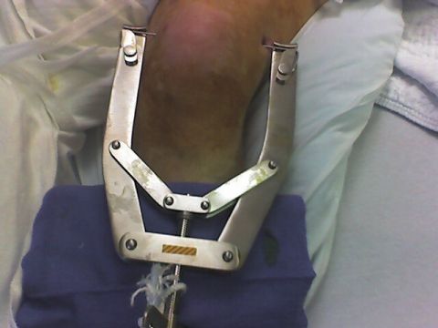 image of the clamp in the knee